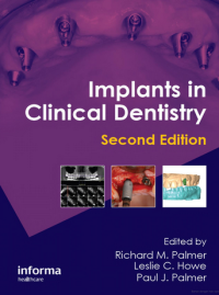 Image of Implants in Clinical Dentistry